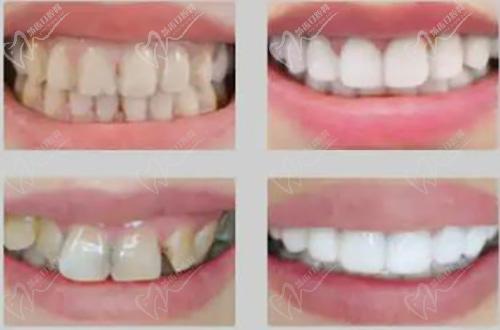 牙貼面有哪些注意事項(xiàng)