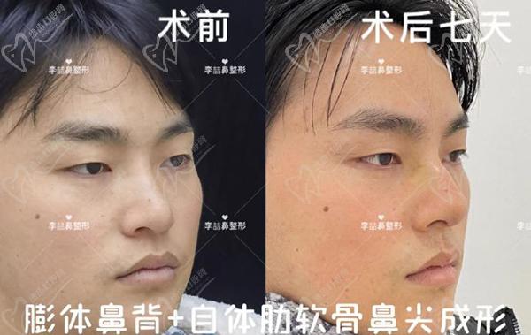 重慶李喆做鼻子怎么樣？口碑評價