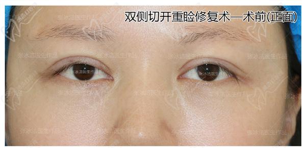 張冰潔雙眼皮修復(fù)案 例圖：肉條腫過寬過深、睜眼費(fèi)力眼睛無神
