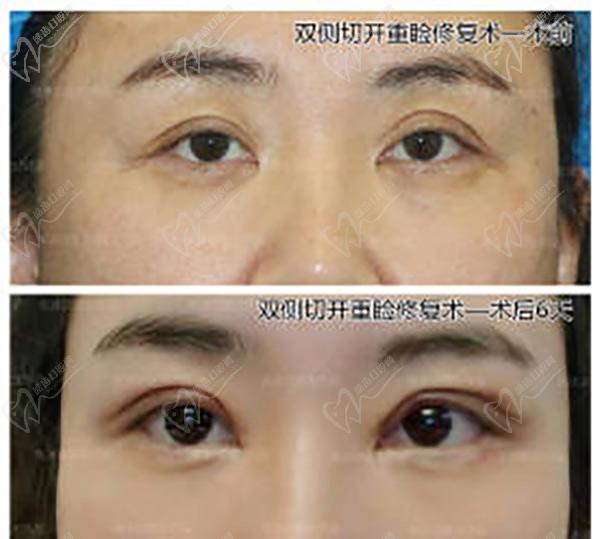 張冰潔雙眼皮修復(fù)案 例圖：不對稱、三角眼