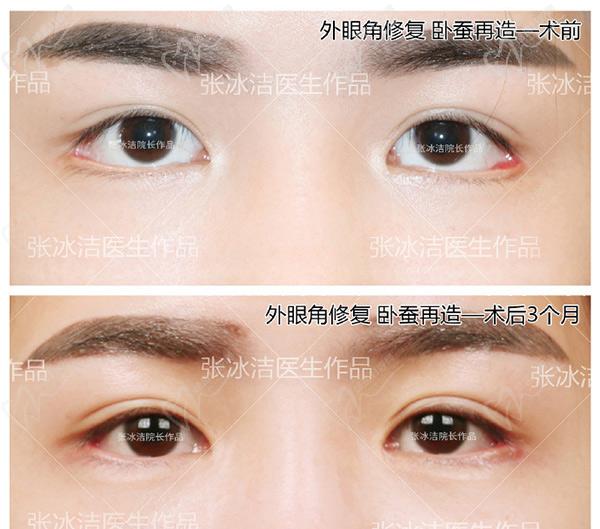 張冰潔外眼角修復(fù)案 例圖：外眼角術(shù)后粘連