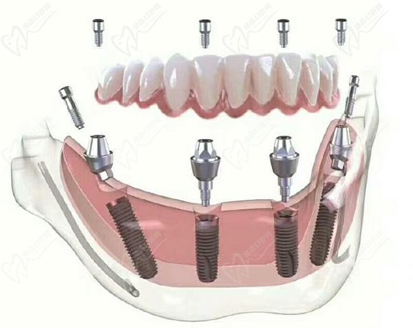 、瑞士iti種植牙半口即刻種植優(yōu)勢