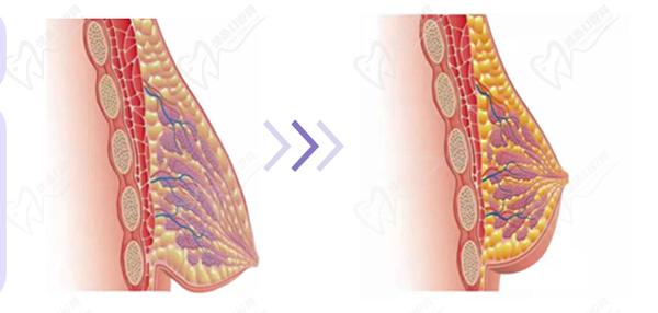 深圳南雅整形醫(yī)院做提胸手術(shù)怎么樣？