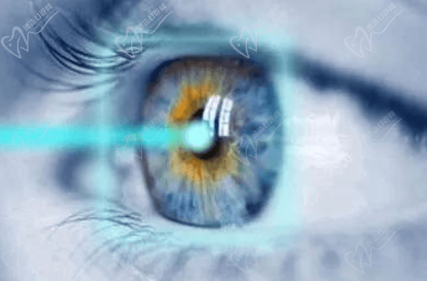 全飛秒近視手術