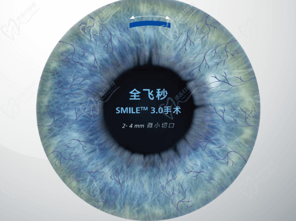 深圳普瑞眼科近視手術怎么樣