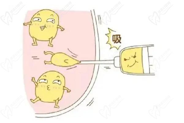 哈爾濱羽禪醫(yī)美楊宇梓腰腹環(huán)吸真實(shí)實(shí)例分享