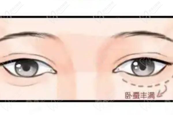 手術(shù)5W花得值-淺談杜園園脂肪填充去眼袋厲害的八個(gè)地方和修復(fù)的口碑與質(zhì)量